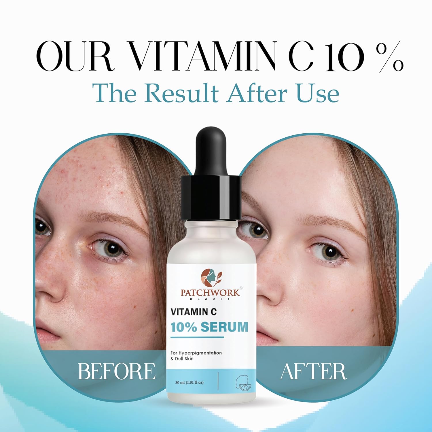 Patchwork Beauty Vitamin C 10% Serum for Hyperpigmentation and Dull Skin, 30 ml